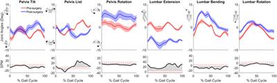 Changes in walking function and neural control following pelvic cancer surgery with reconstruction